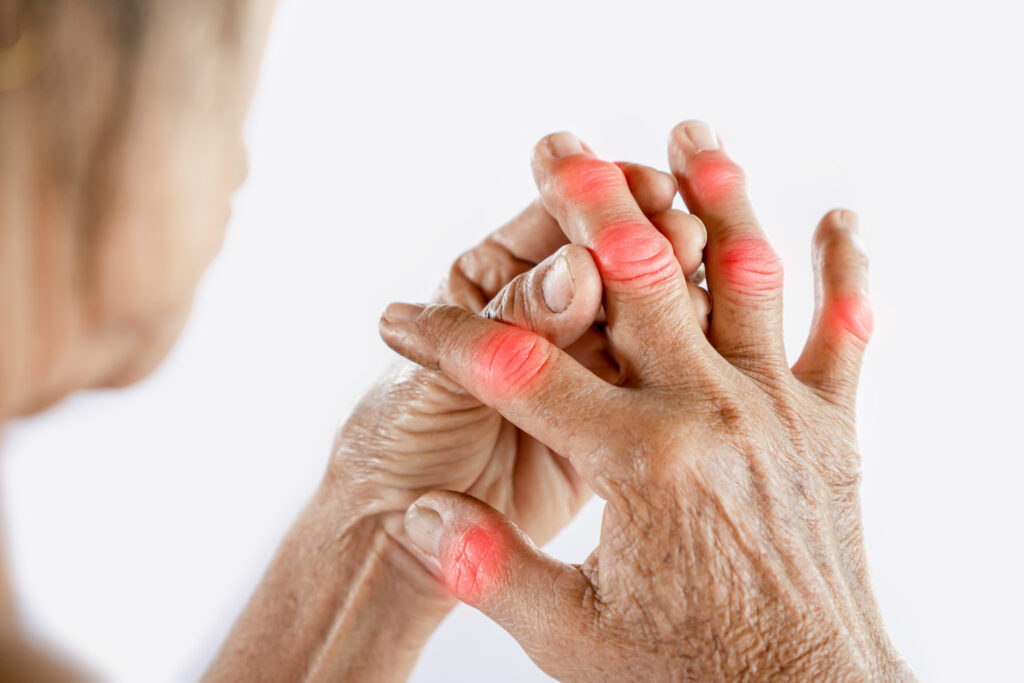 Persons hand showing redness on joints of fingers